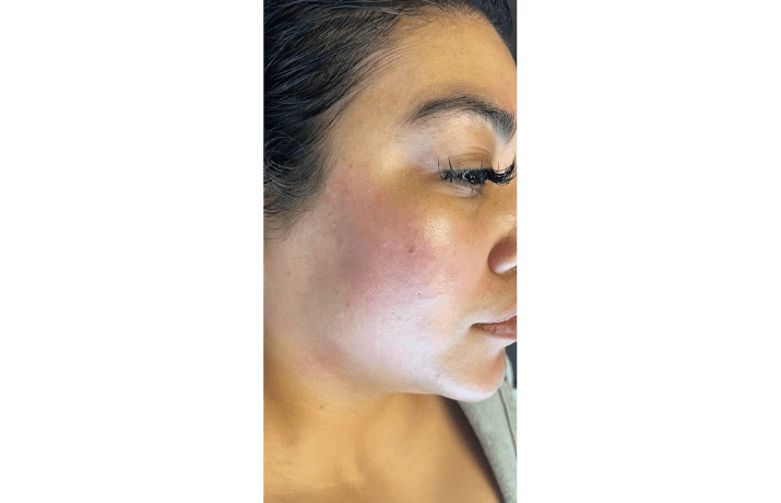 hydrofacial after