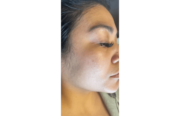 hydrofacial before